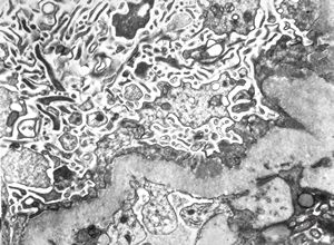 M,39y. | membranous glomerulopathy M,39y. | membranous glomerulopathy